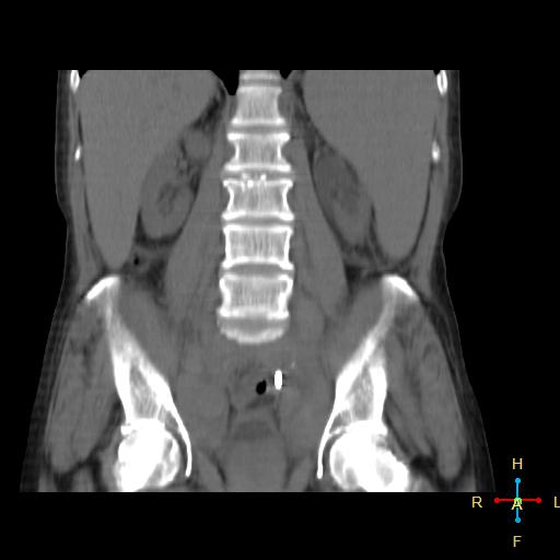 File:Abdominal lymphoma (Radiopaedia 23085-23115 Coronal non-contrast 9).jpg