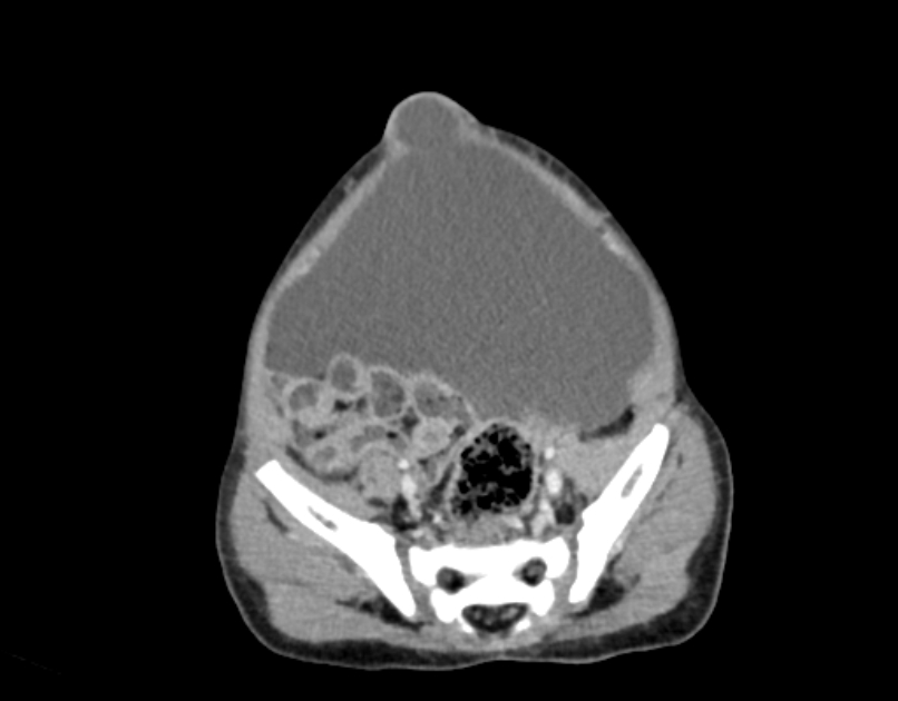 Abdominal premesenteric cystic lymphangioma (Radiopaedia 82995-97350 Axial C+ portal venous phase 53).jpg
