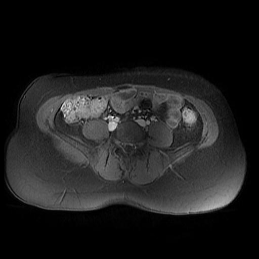 File:Abdominal wall endometriosis (Radiopaedia 83702-98847 Axial T1 C+ fat sat 15).jpg