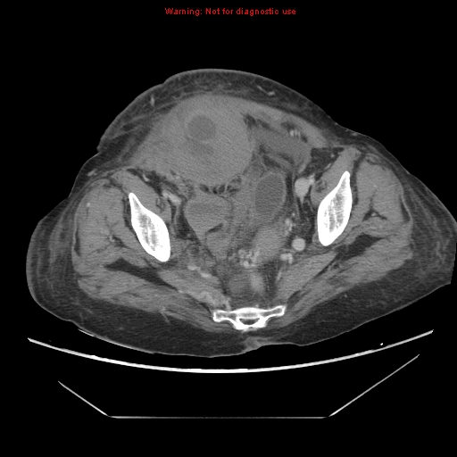 File:Abdominal wall hematoma (Radiopaedia 9427-10112 Axial C+ portal venous phase 93).jpg