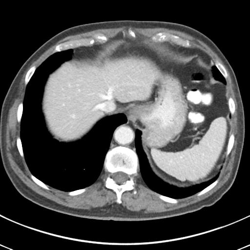 Abdominal wall metastasis from colorectal carcinoma (Radiopaedia 31016-31717 Axial C+ portal venous phase 14).jpg