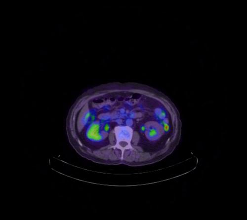 Abdominal wall metastasis from colorectal carcinoma (Radiopaedia 31016-31719 Axial 68).jpg