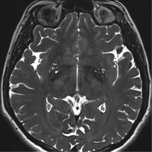 Abducens nerve palsy (Radiopaedia 51069-56648 Axial T2 fat sat 87).png