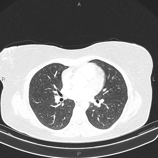 Aberrant right subclavian artery (Radiopaedia 87334-103629 Axial lung window 36).jpg