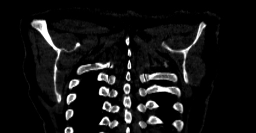 Accesory rib joint (Radiopaedia 71987-82452 Coronal bone window 80).jpg