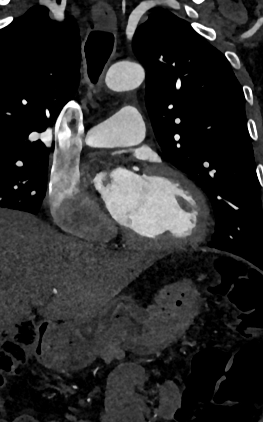 Accessory left atrial appendage (Radiopaedia 81987-95968 Coronal C+ arterial phase 47).jpg