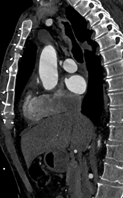 Accessory left atrial appendage (Radiopaedia 81987-95968 Sagittal C+ arterial phase 31).jpg