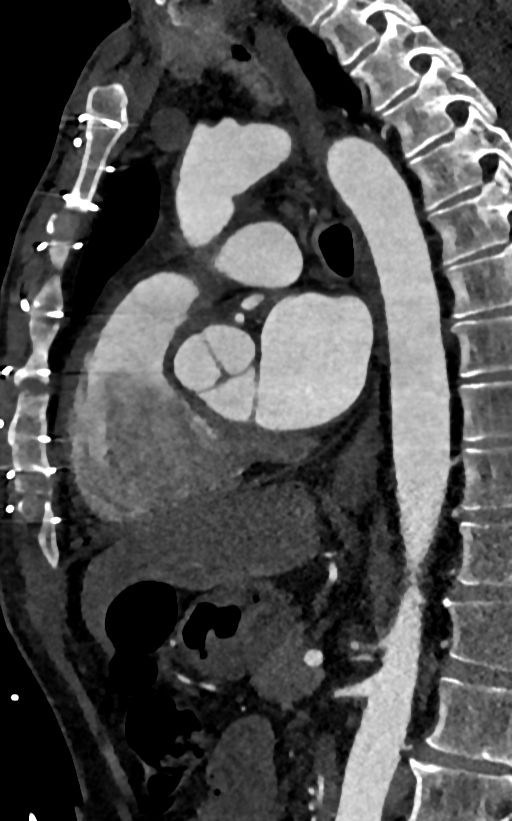 Accessory left atrial appendage (Radiopaedia 81987-95968 Sagittal C+ arterial phase 65).jpg
