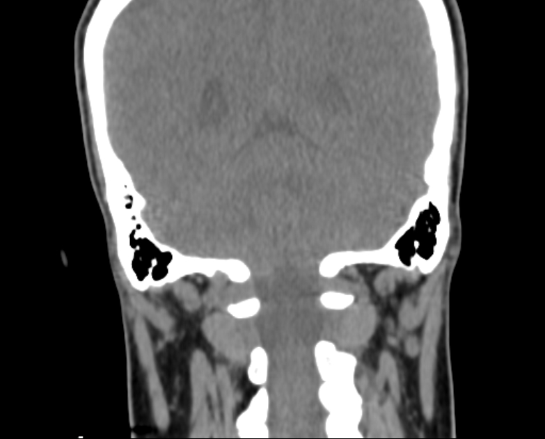 Accessory parotid gland (Radiopaedia 76207-87772 Coronal non-contrast 107).jpg