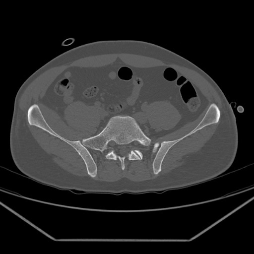 File:Acetabular and ilial fractures (Radiopaedia 59084-66378 Axial bone window 12).jpg