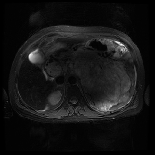 Acinar cell carcinoma of the pancreas (Radiopaedia 75442-86668 Axial T2 fat sat 29).jpg
