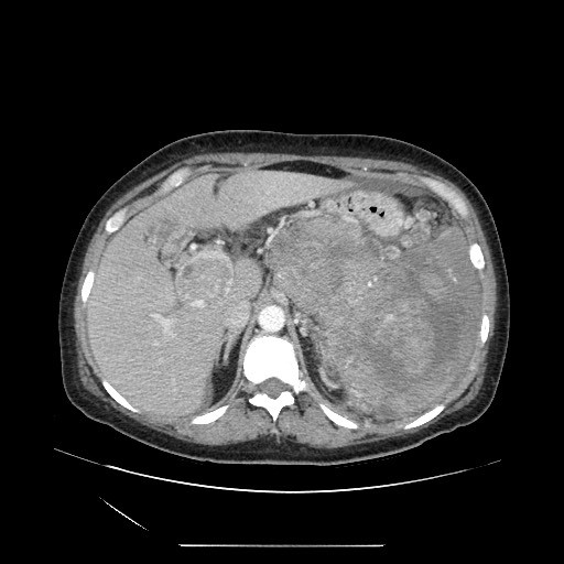 File:Acinar cell carcinoma of the pancreas (Radiopaedia 75442-86669 Axial C+ portal venous phase 37).jpg