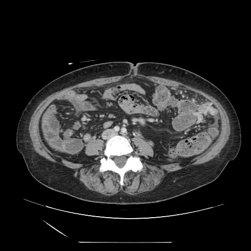 Acinar cell carcinoma of the pancreas (Radiopaedia 75442-86669 Axial C+ portal venous phase 89).jpg