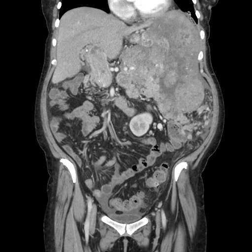 Acinar cell carcinoma of the pancreas (Radiopaedia 75442-86669 Coronal C+ portal venous phase 51).jpg