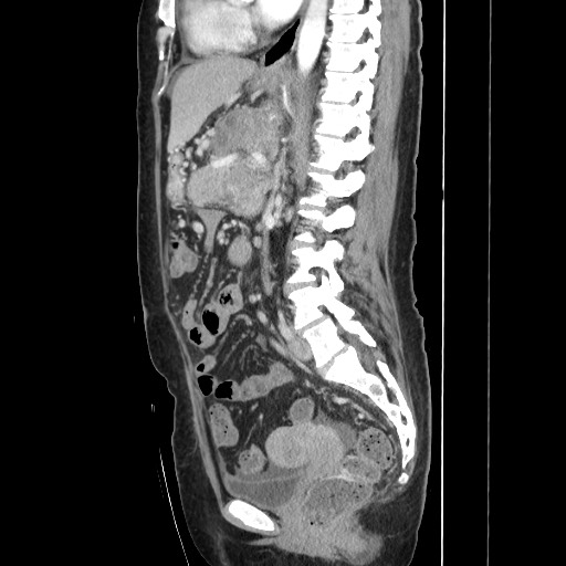 Acinar cell carcinoma of the pancreas (Radiopaedia 75442-86669 Sagittal C+ portal venous phase 105).jpg