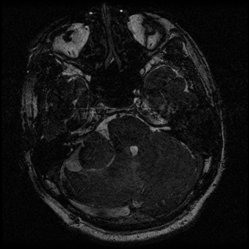 File:Acoustic schwannoma (Radiopaedia 39170-41387 Axial FIESTA 75).png