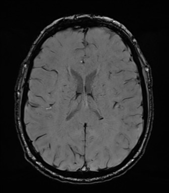 Acoustic schwannoma (Radiopaedia 50846-56358 Axial SWI 57).png