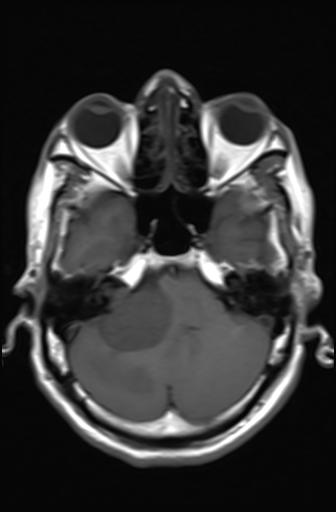 Acoustic schwannoma - probable (Radiopaedia 20386-20292 Axial T1 5).jpg