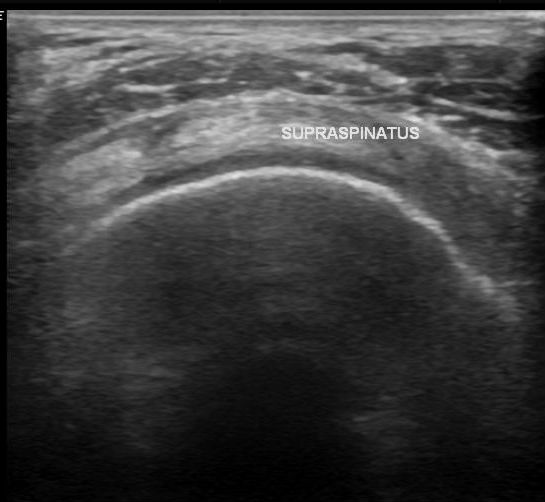 File:Acromial fracture - ultrasound (Radiopaedia 26729-26891 G 1).jpg