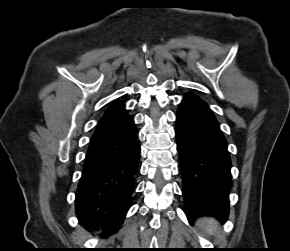 Acromioclavicular joint cyst (Radiopaedia 58455-65610 Coronal C+ arterial phase 118).jpg