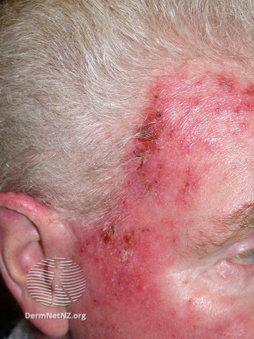 Actinic Keratoses treated with imiquimod (DermNet NZ lesions-ak-imiquimod-3763).jpg