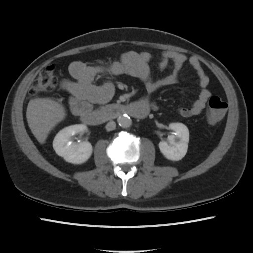 File:Active colonic bleed on CT (Radiopaedia 49765-55025 Axial C+ delayed 37).jpg