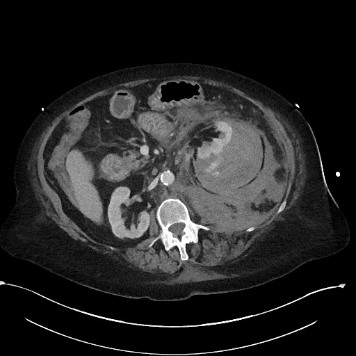 File:Active renal extravasation with large subcapsular and retroperitoneal hemorrhage (Radiopaedia 60975-68796 Axial 265).jpg