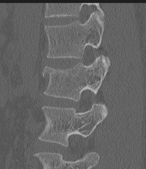 Acute L1 burst compression fracture (Radiopaedia 34430-35755 Sagittal bone window 23).png