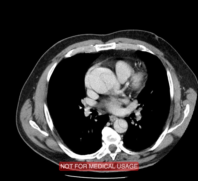 Acute aortic dissection - Stanford type A (Radiopaedia 40661-43285 Axial C+ portal venous phase 27).jpg