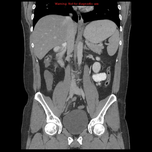File:Acute appendicitis (Radiopaedia 10498-10973 F 22).jpg