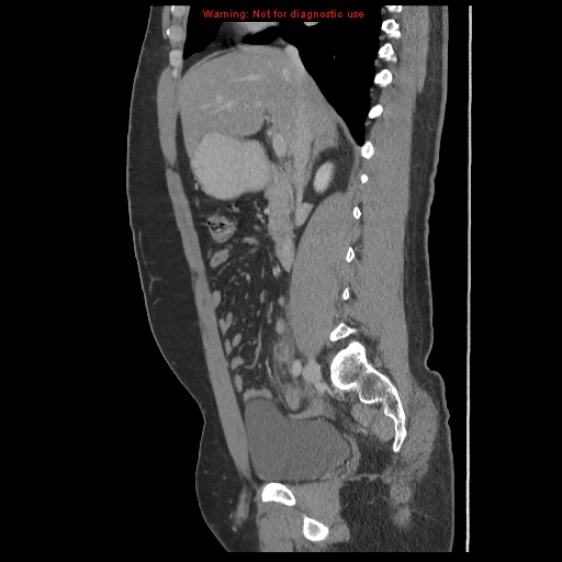 File:Acute appendicitis (Radiopaedia 10498-10973 Sagittal C+ portal venous phase 20).jpg