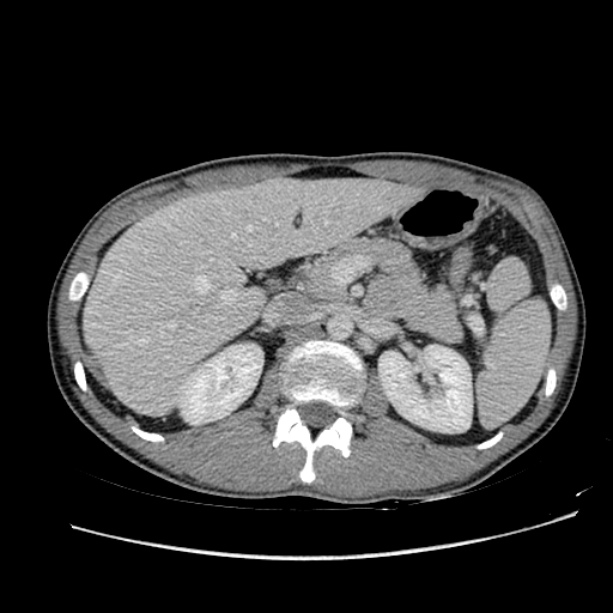 Acute appendicitis (Radiopaedia 27049-27227 Axial C+ portal venous phase 22).jpg