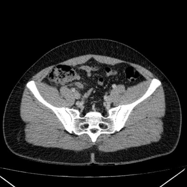 File:Acute appendicitis (Radiopaedia 38255-40270 Axial C+ portal venous phase 85).jpg