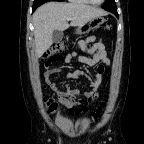 File:Acute appendicitis (Radiopaedia 38255-40270 Coronal C+ portal venous phase 27).jpg