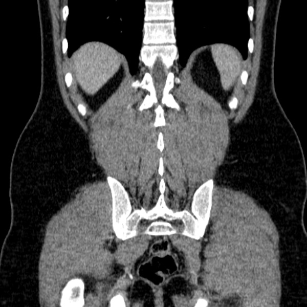 Acute appendicitis (Radiopaedia 38255-40270 Coronal C+ portal venous phase 70).jpg