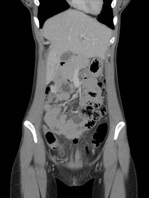 Acute appendicitis (Radiopaedia 62608-70901 Coronal C+ portal venous phase 9).jpg