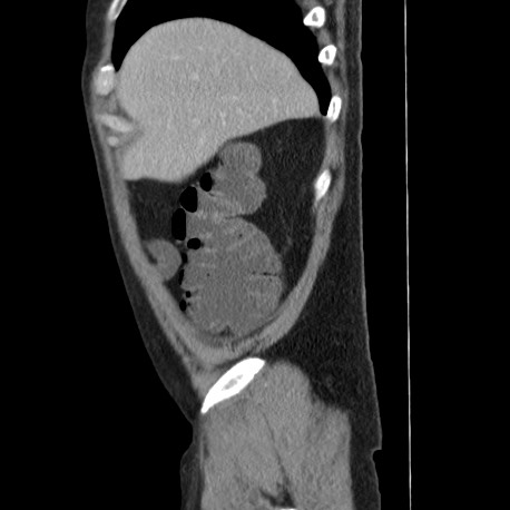 Acute appendicitis (Radiopaedia 66513-75790 Sagittal C+ portal venous phase 17).jpg