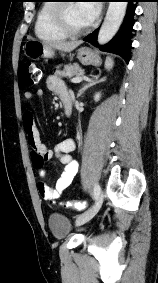 Acute appendicitis (Radiopaedia 77016-88960 Sagittal C+ portal venous phase 45).jpg