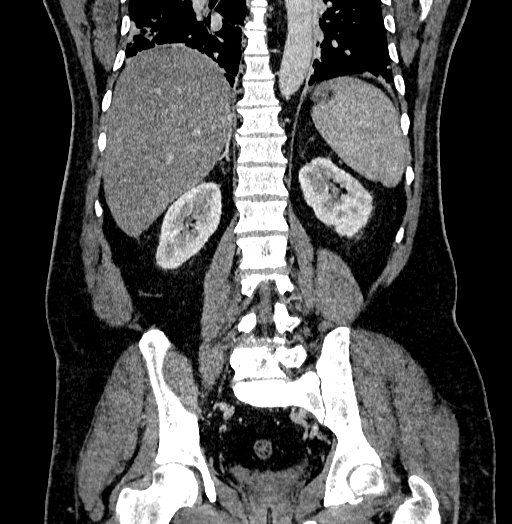 Acute appendicitis (Radiopaedia 79950-93224 Coronal C+ portal venous phase 65).jpg