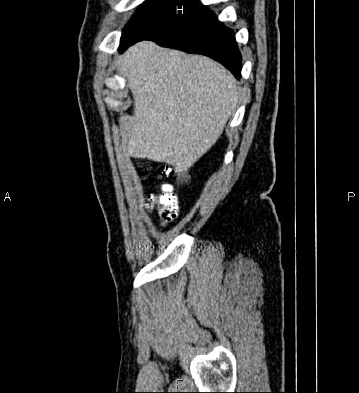 Acute appendicitis (Radiopaedia 84780-100240 Sagittal C+ portal venous phase 9).jpg