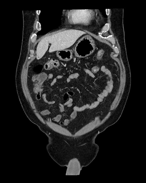 Acute appendicitis - large appendicoliths (Radiopaedia 61805-69820 Coronal C+ portal venous phase 34).jpg