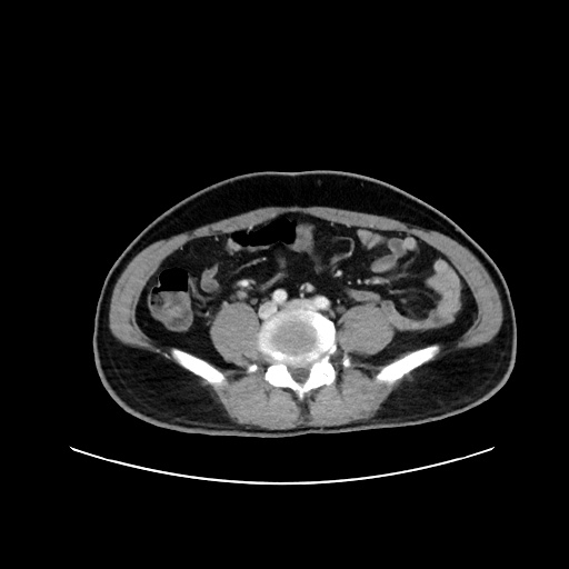 Acute appendicitis and COVID 19 pneumonia (Radiopaedia 76604-88380 Axial C+ portal venous phase 53).jpg