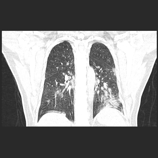 Acute appendicitis and COVID 19 pneumonia (Radiopaedia 76604-88380 G 45).jpg