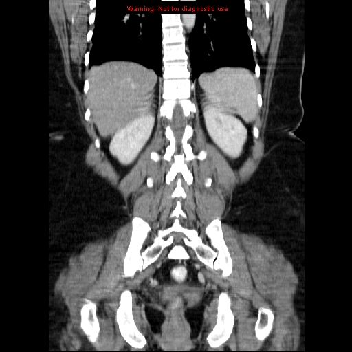 Acute appendicitis complicated by ovarian vein thrombophlebitis (Radiopaedia 16172-15851 Coronal C+ portal venous phase 61).jpg