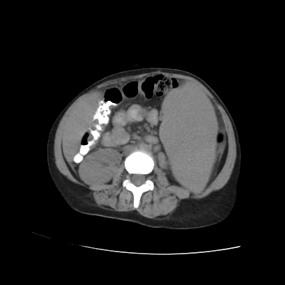 File:Acute calculous cholecystitis in patient with osteopetrosis (Radiopaedia 77871-90159 Axial non-contrast 47).jpg