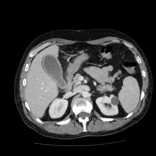 Acute cholecystitis and incidental left sided IVC (Radiopaedia 49352-54459 Axial C+ portal venous phase 56).jpg