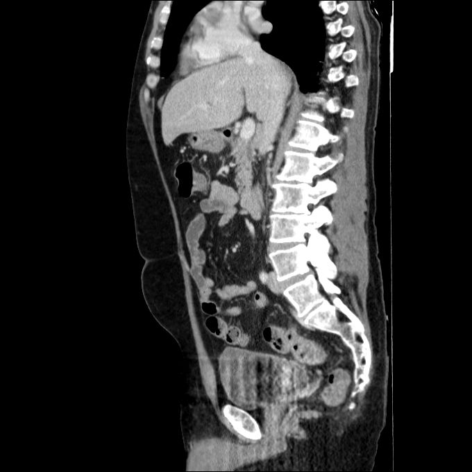 Acute cholecystitis and incidental left sided IVC (Radiopaedia 49352-54459 Sagittal C+ portal venous phase 51).jpg