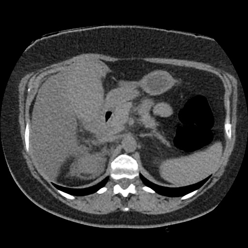 Acute cholecystitis and ureteric colic (Radiopaedia 42330-45444 Axial prone 26).jpg
