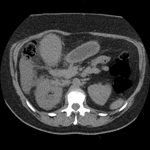 Acute cholecystitis and ureteric colic (Radiopaedia 42330-45444 Axial prone 32).jpg