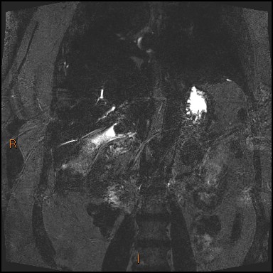 File:Acute cholecystitis with gallbladder neck calculus (Radiopaedia 42795-45971 Coronal Turbo spin echo 12).jpg